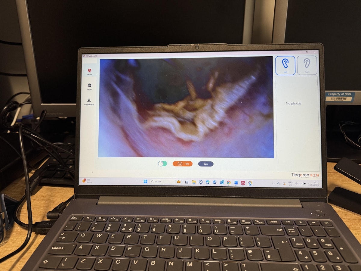 Having a video otoscopy